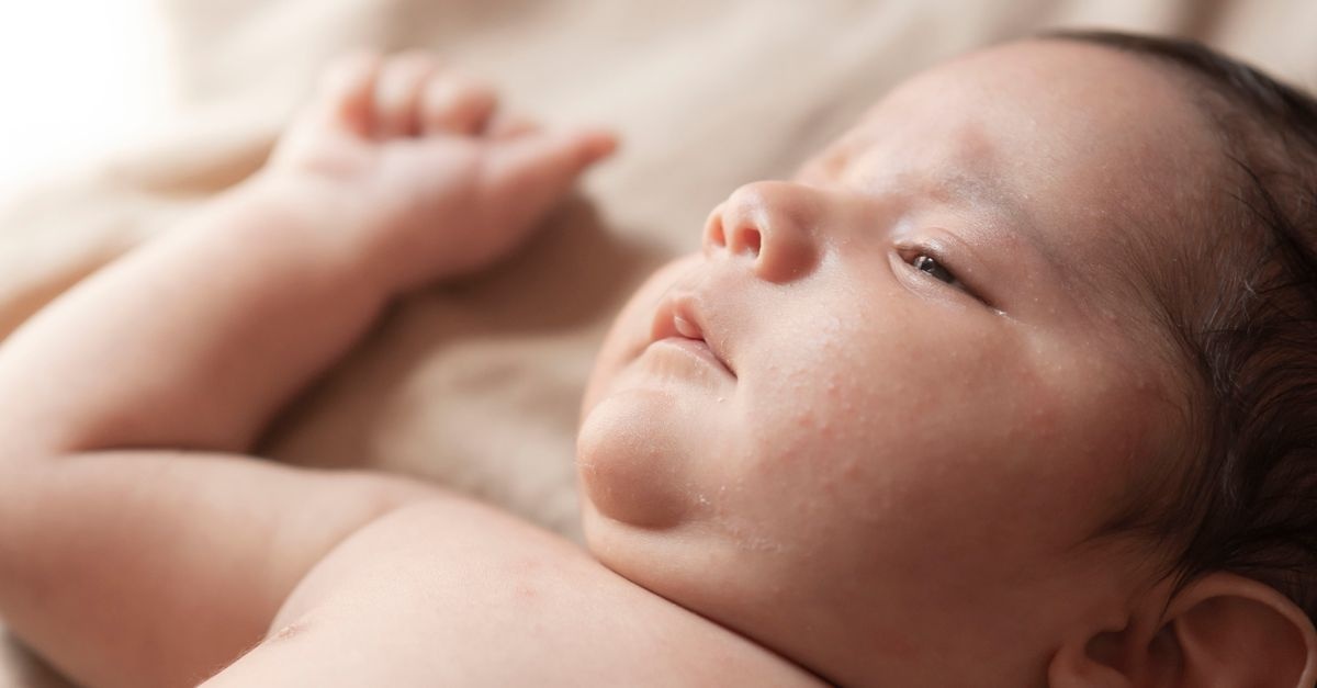 Crosta lattea nei neonati: rimedi dolci e consigli pratici per una pelle serena